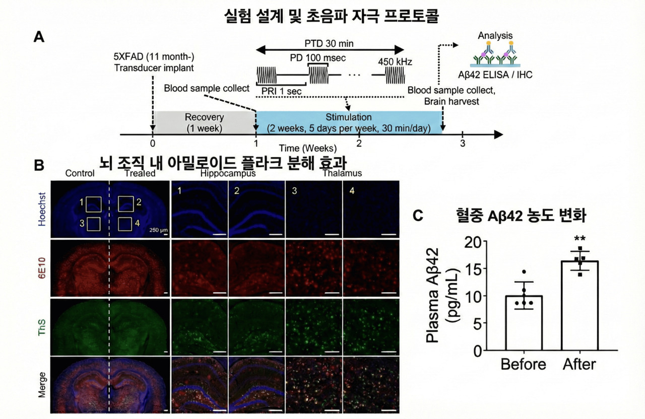 [김태열의 생생건강S펜] “국내연구진,약물 없이 초음파로 알츠하이머 원인 물질 65% 제거 확인”