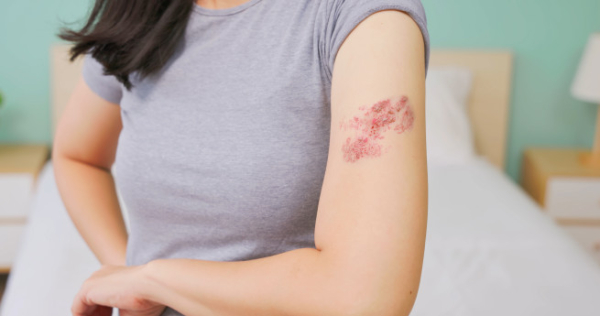 대상포진, 초기 대응이 중요…72시간 내 치료해야 예후 좋아[e건강~쏙]