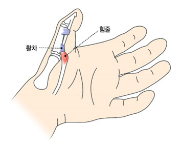 손가락에서 '딸깍' '방아쇠 손가락'... 반복되는 동작으로 발생